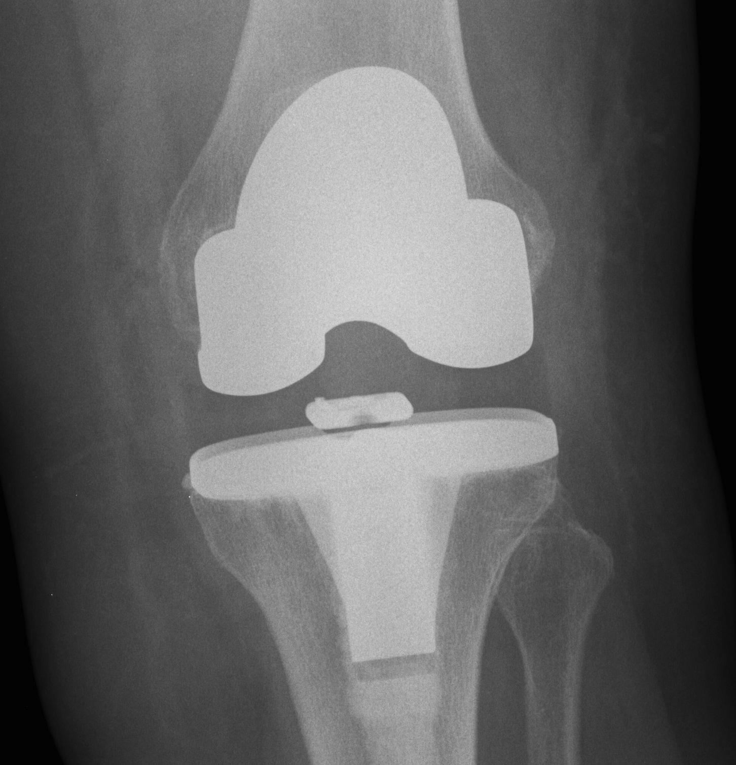 TKR Instability Increase Poly Thickness